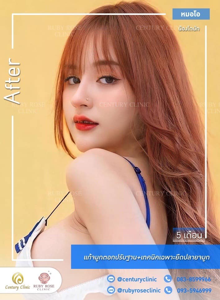 Century-รีวิว-แก้จมูก 1#421