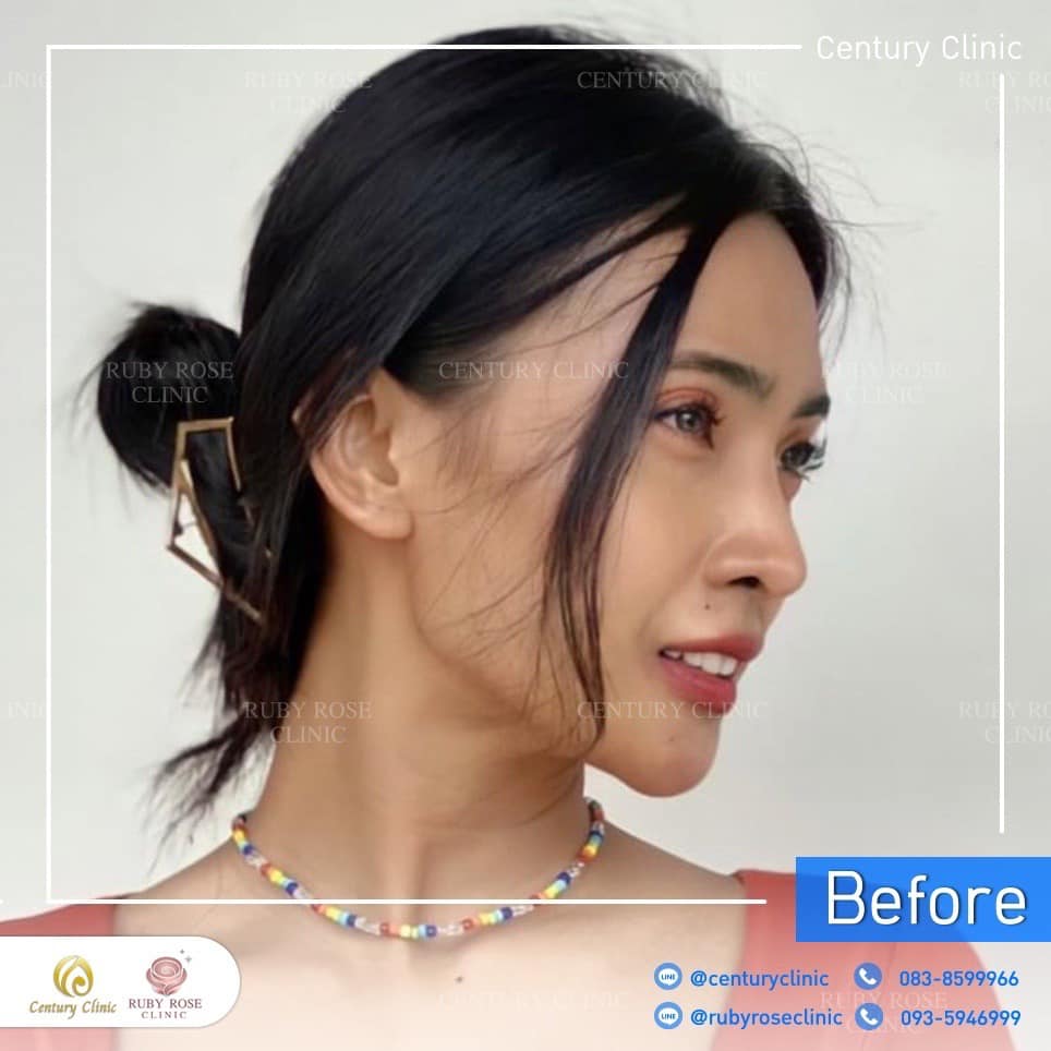 รีวิว แก้จมูก #359 , Century Clinic Thailand Century-รีวิว-แก้จมูก 2#359
