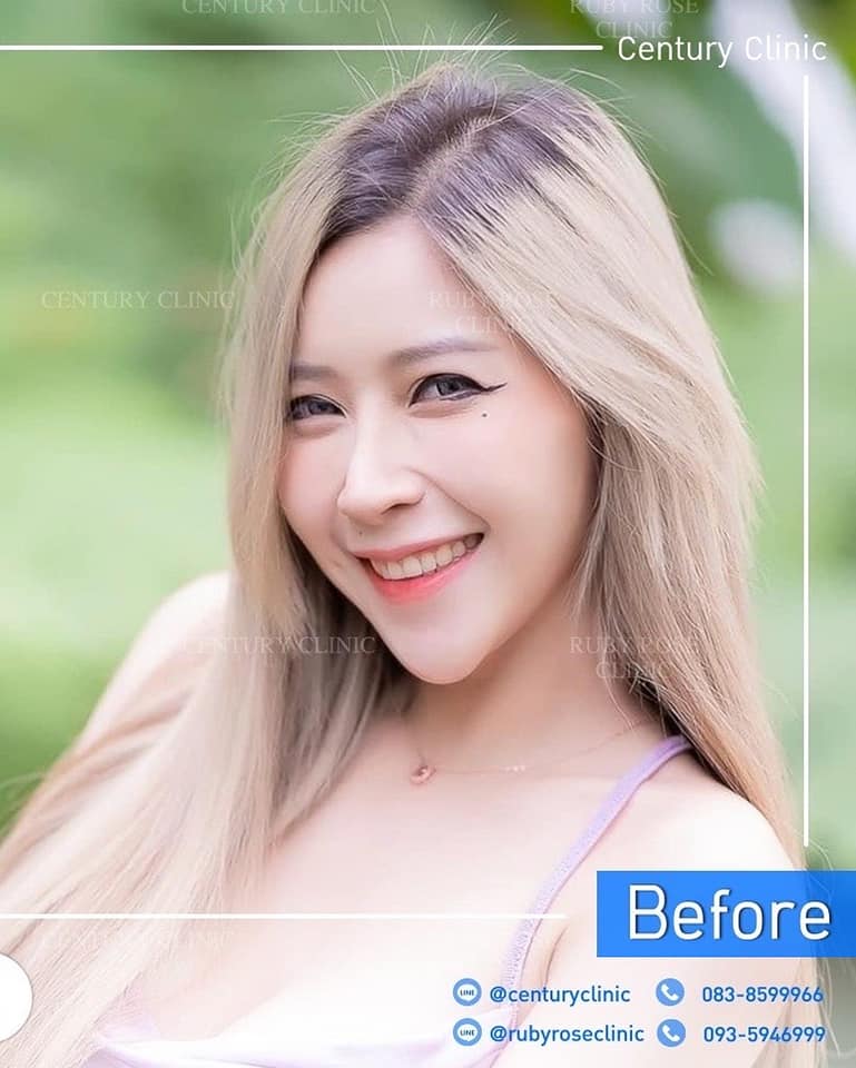 Century-รีวิว-แก้จมูก 2#361