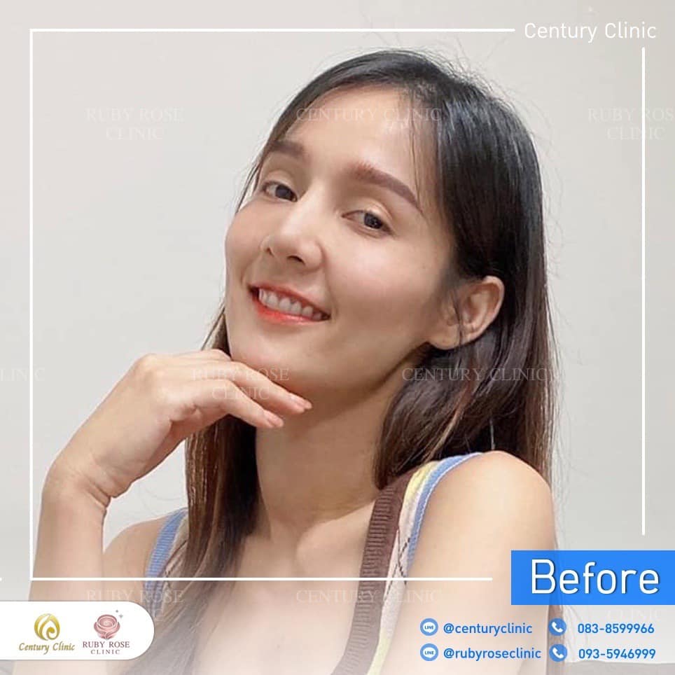 รีวิว แก้จมูก #365 , Century Clinic Thailand Century-รีวิว-แก้จมูก 2#365