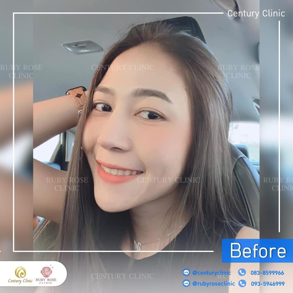 Century-รีวิว-แก้จมูก 2#366
