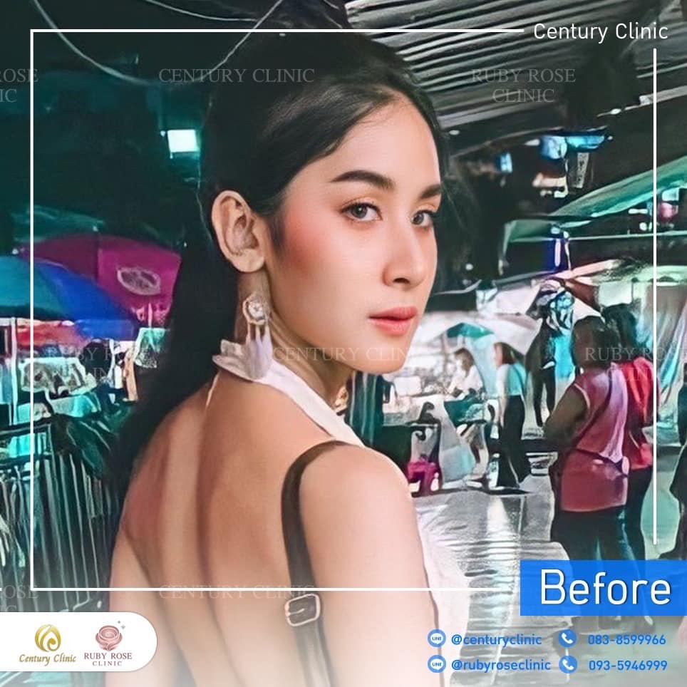 Century-รีวิว-แก้จมูก 2#368