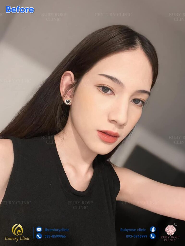 รีวิว แก้จมูก #371 , Century Clinic Thailand Century-รีวิว-แก้จมูก 2#371