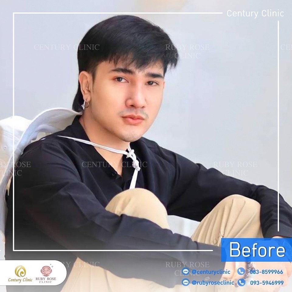 รีวิว แก้จมูก #377 , Century Clinic Thailand Century-รีวิว-แก้จมูก 2#377