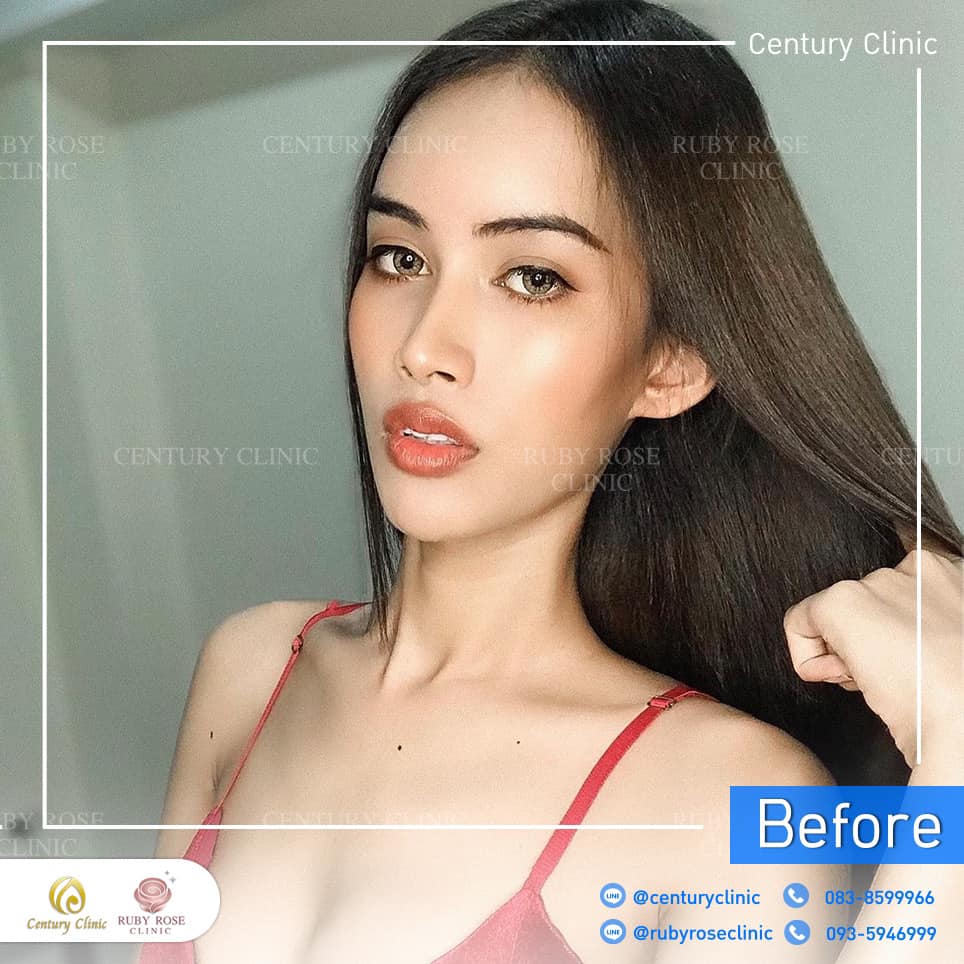 Century-รีวิว-แก้จมูก 2#387