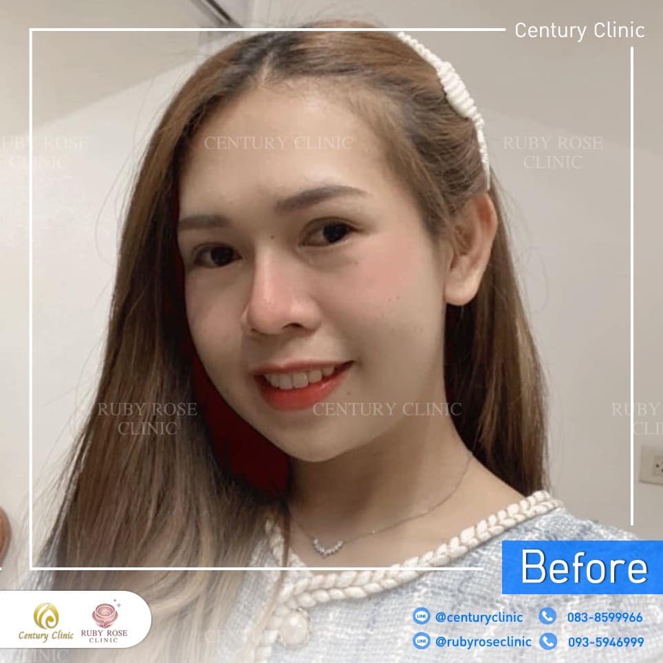 Century-รีวิว-แก้จมูก 2#395