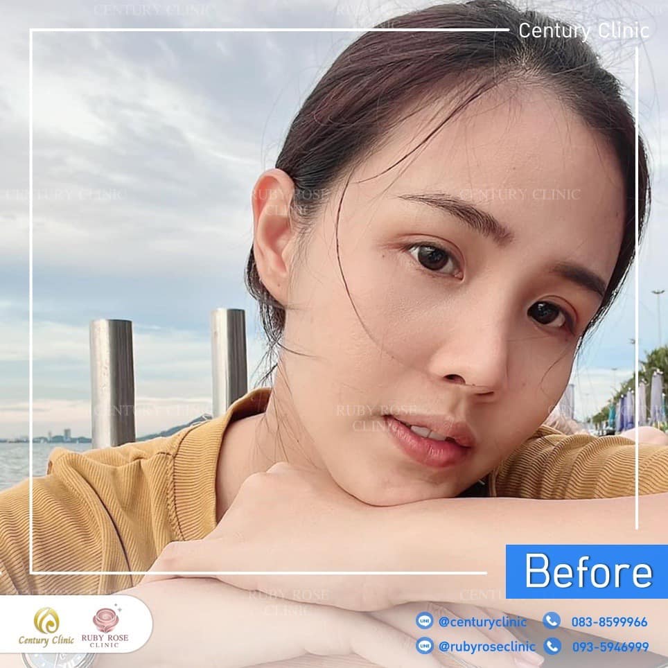 Century-รีวิว-แก้จมูก 2#400