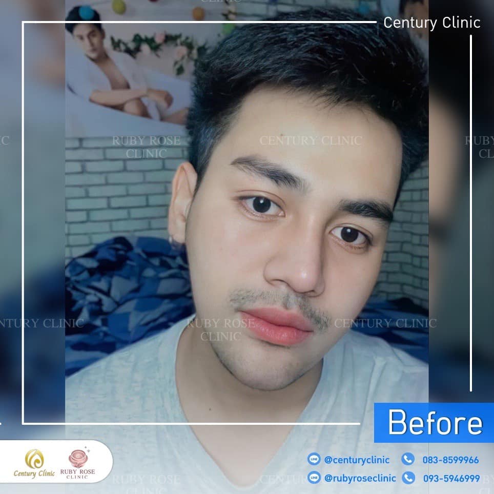 รีวิว แก้จมูก #403 , Century Clinic Thailand Century-รีวิว-แก้จมูก 2#403