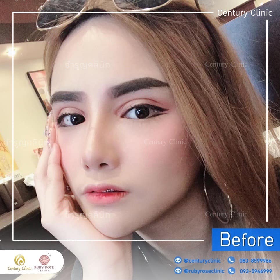 Century-รีวิว-แก้จมูก 2#414