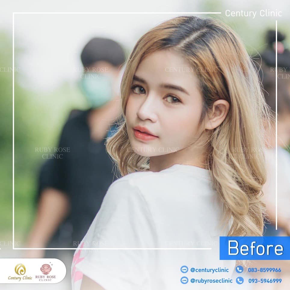 Century-รีวิว-แก้จมูก 2#418