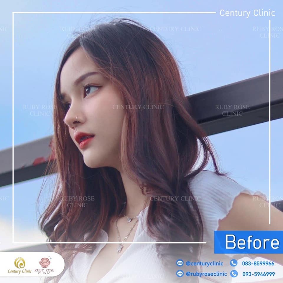Century-รีวิว-แก้จมูก 2#421