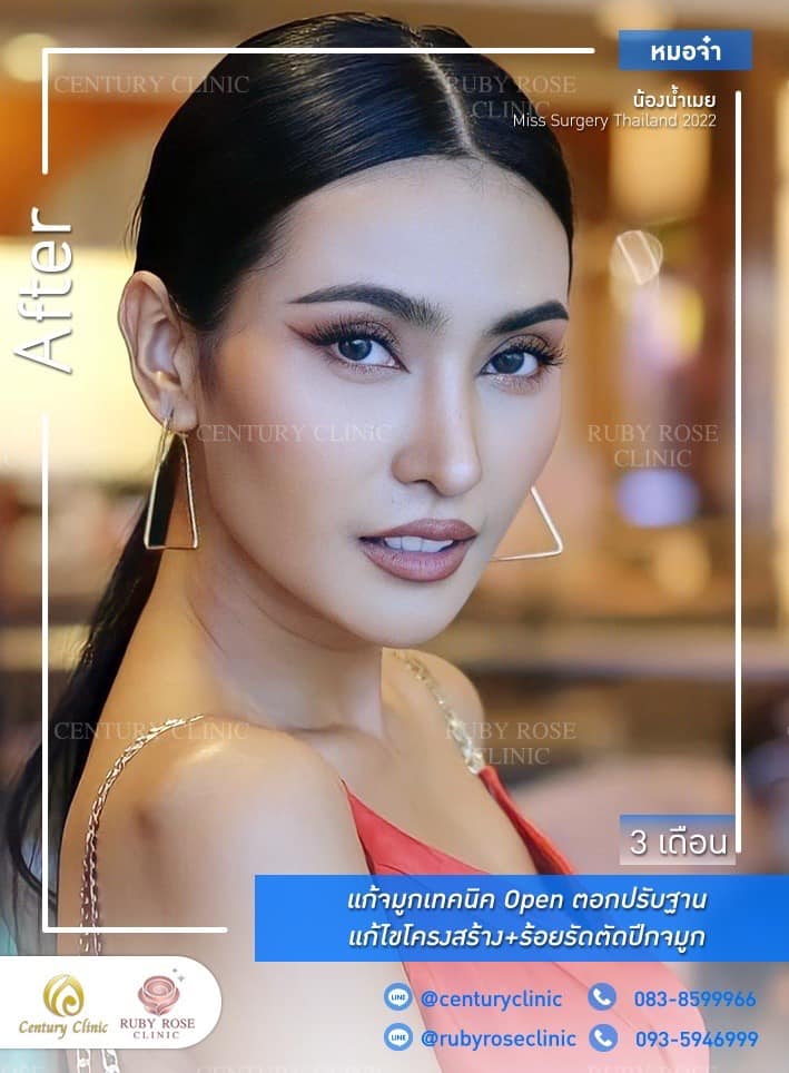 Century-รีวิว-แก้จมูก #359