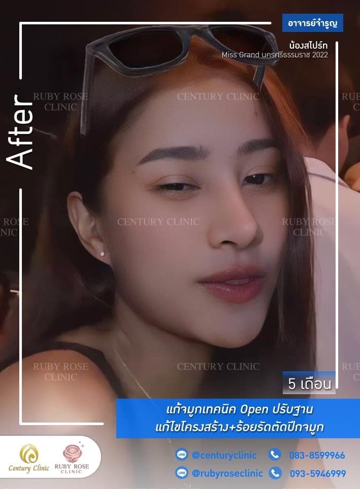 Century-รีวิว-แก้จมูก #360