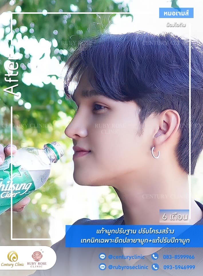 Century-รีวิว-แก้จมูก #362