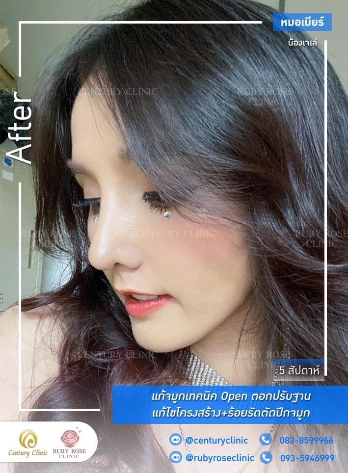 Century-รีวิว-แก้จมูก #365