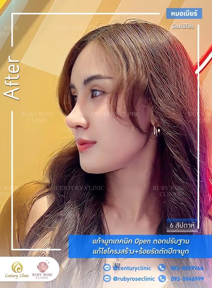 Century-รีวิว-แก้จมูก #368