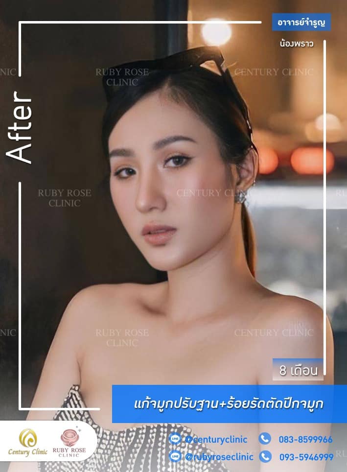 Century-รีวิว-แก้จมูก #369