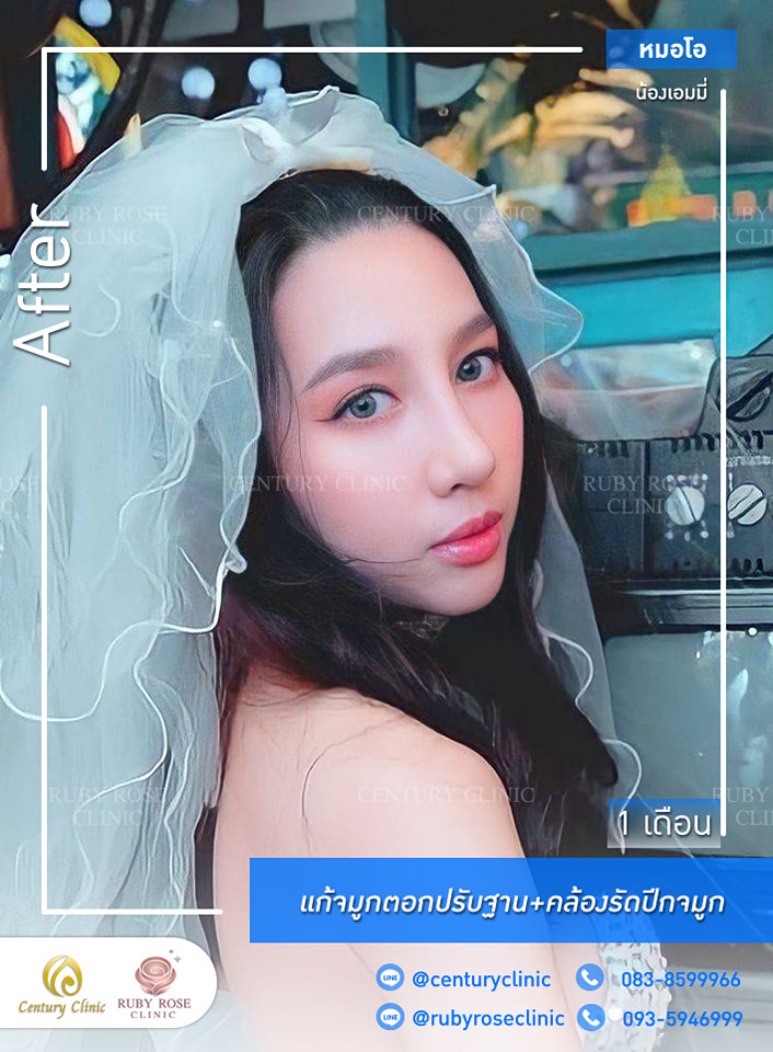 รีวิว แก้จมูก #370 , Century Clinic Thailand Century-รีวิว-แก้จมูก #370