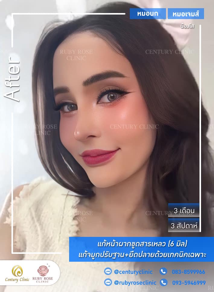 Century-รีวิว-แก้จมูก #376