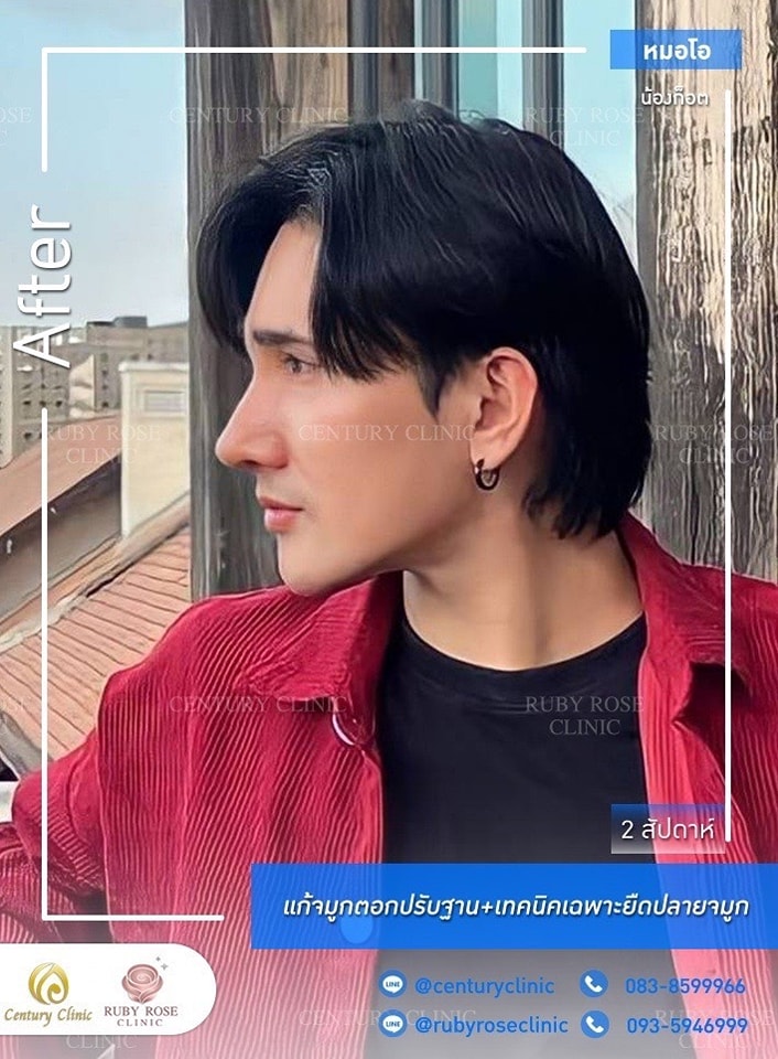 Century-รีวิว-แก้จมูก #377