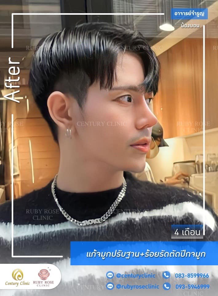 Century-รีวิว-แก้จมูก #383