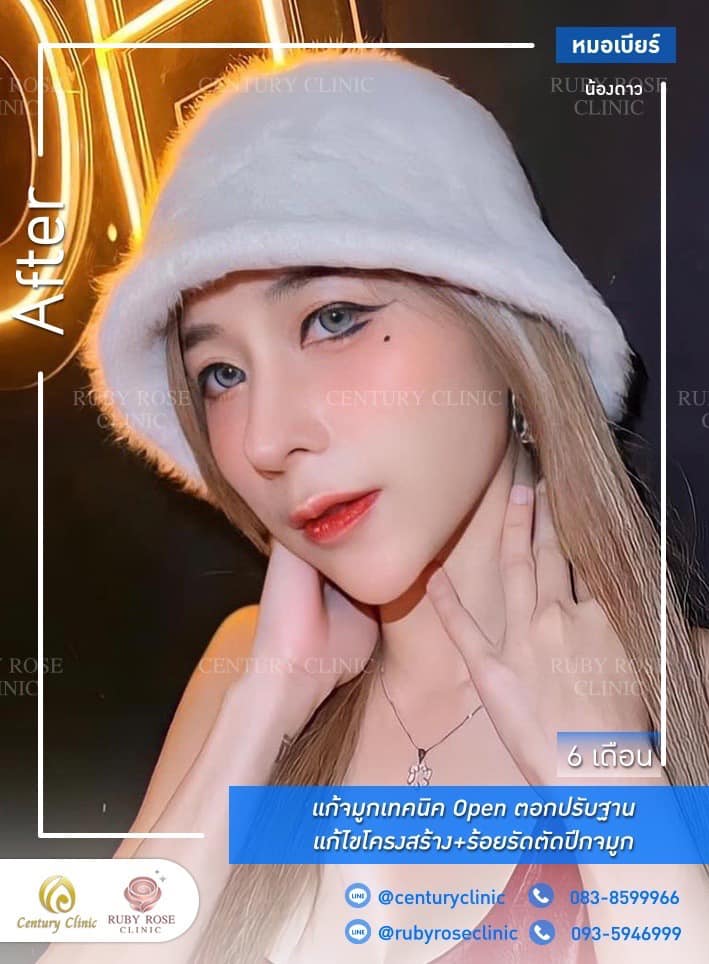 Century-รีวิว-แก้จมูก #384