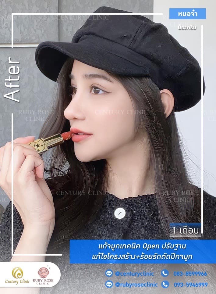 Century-รีวิว-แก้จมูก #385