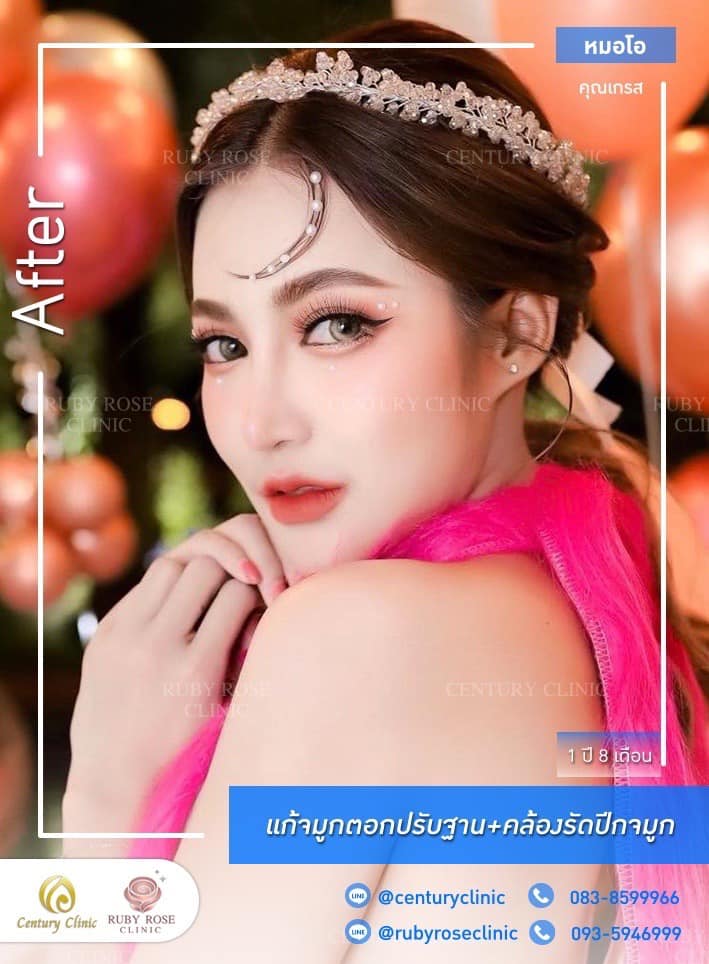 Century-รีวิว-แก้จมูก #392