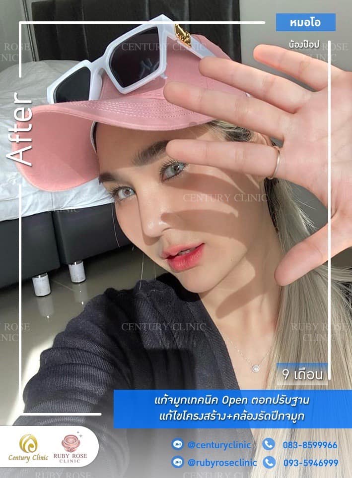 รีวิว แก้จมูก #397