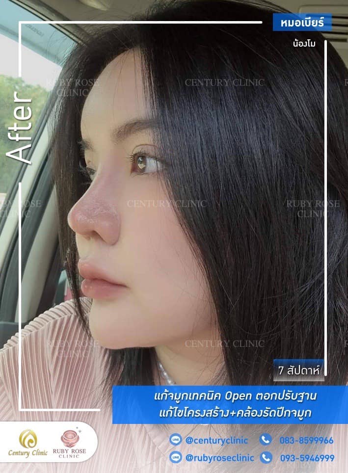 Century-รีวิว-แก้จมูก #398