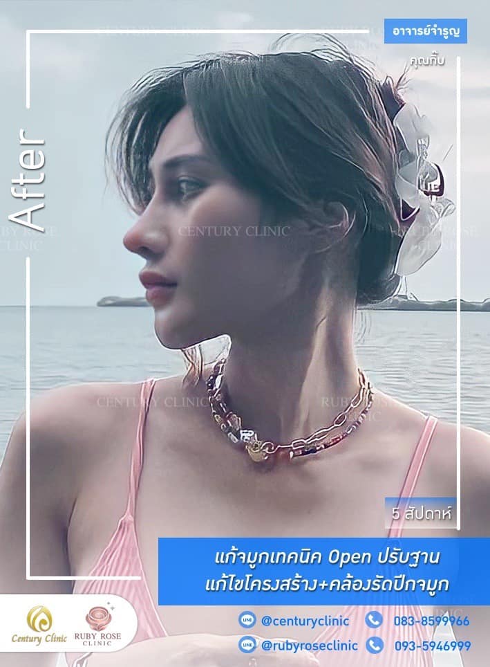 Century-รีวิว-แก้จมูก #399