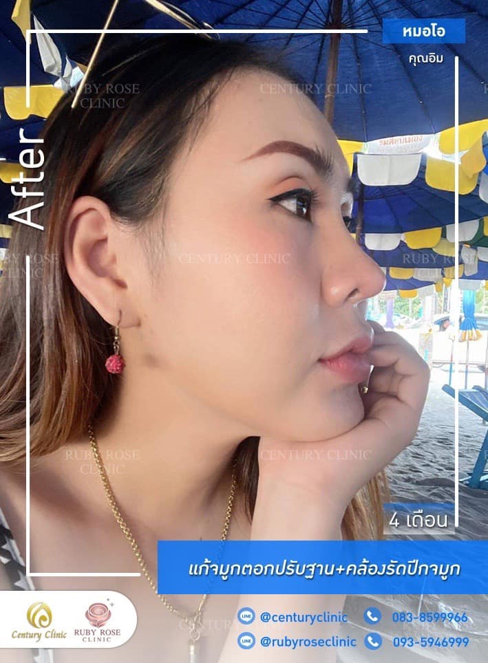 Century-รีวิว-แก้จมูก #402
