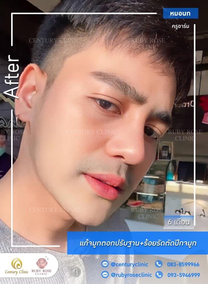 รีวิว แก้จมูก #403 , Century Clinic Thailand Century-รีวิว-แก้จมูก #403