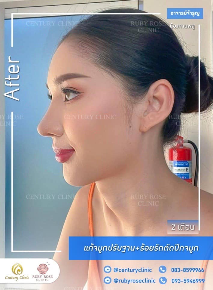 Century-รีวิว-แก้จมูก #405