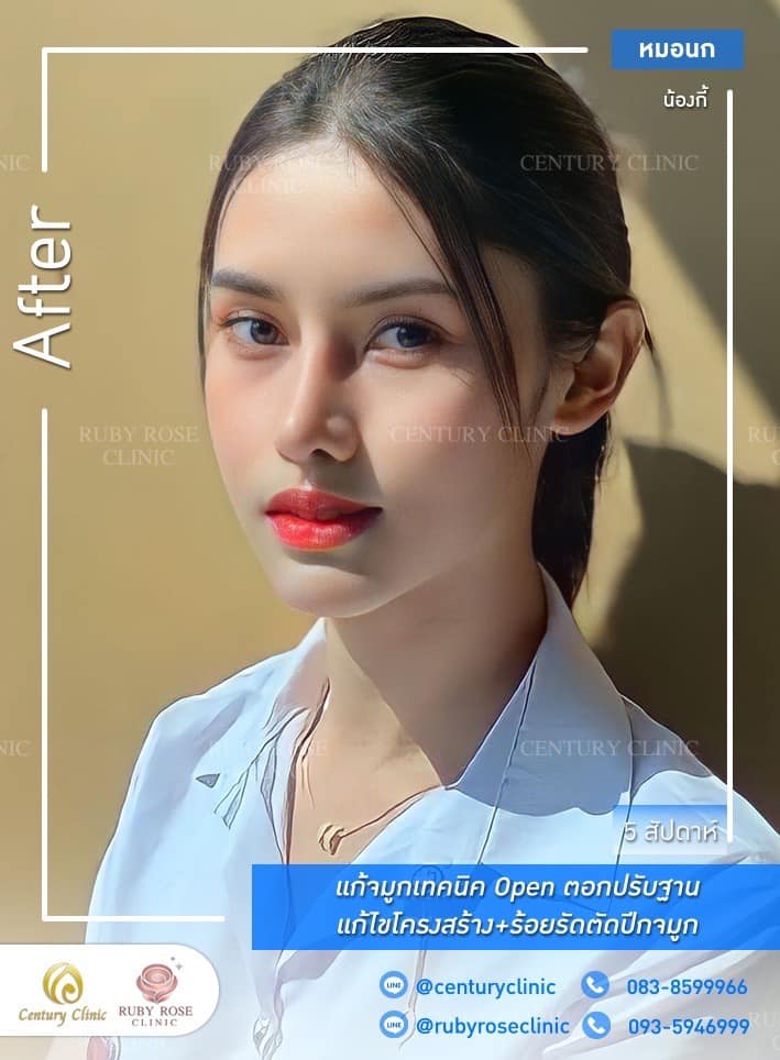 Century-รีวิว-แก้จมูก #407