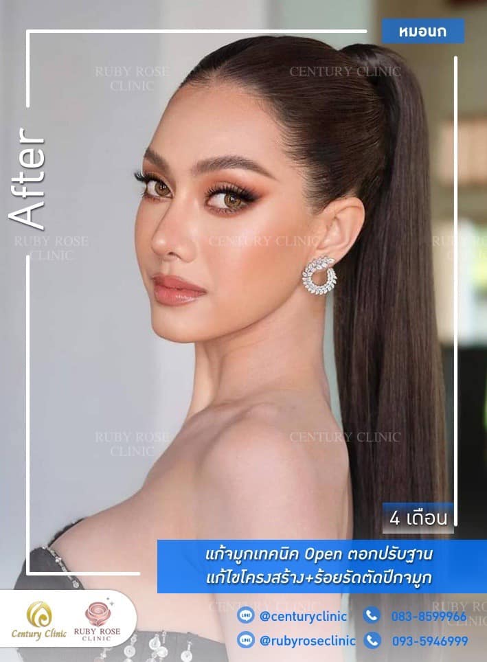 Century-รีวิว-แก้จมูก #411