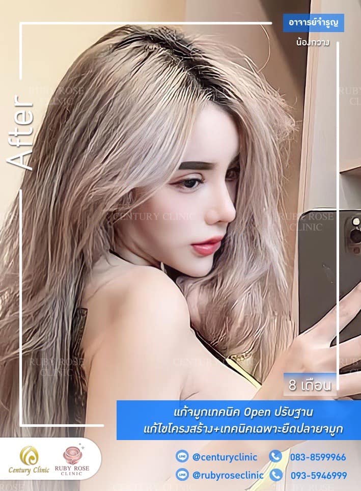 Century-รีวิว-แก้จมูก #414