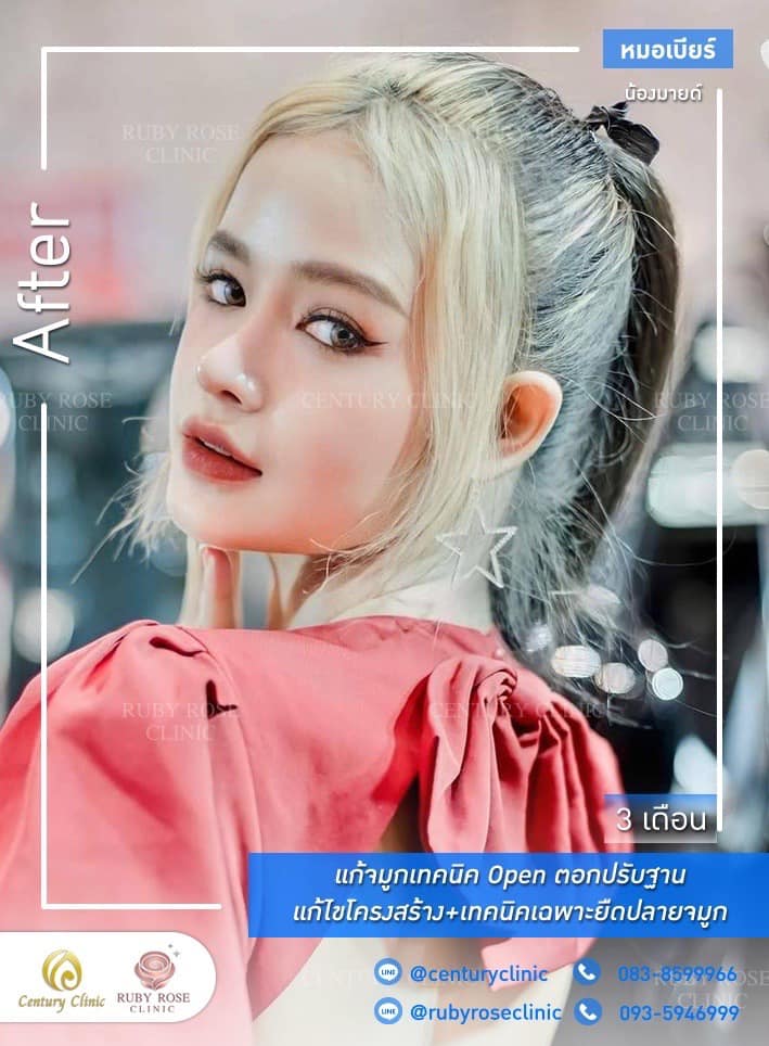 รีวิว แก้จมูก #418