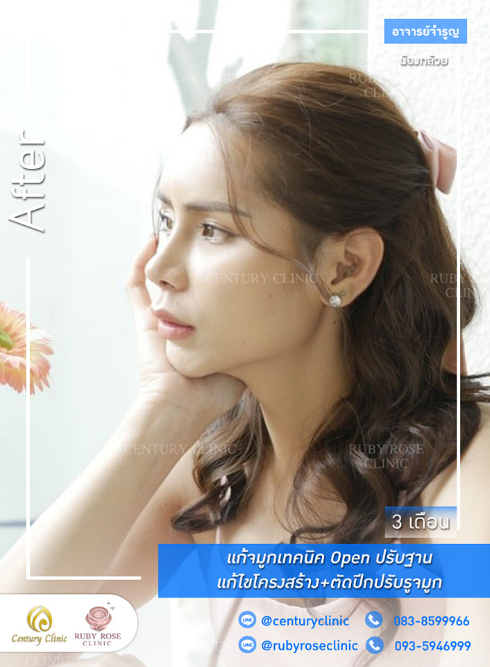 Century-รีวิว-แก้จมูก #419