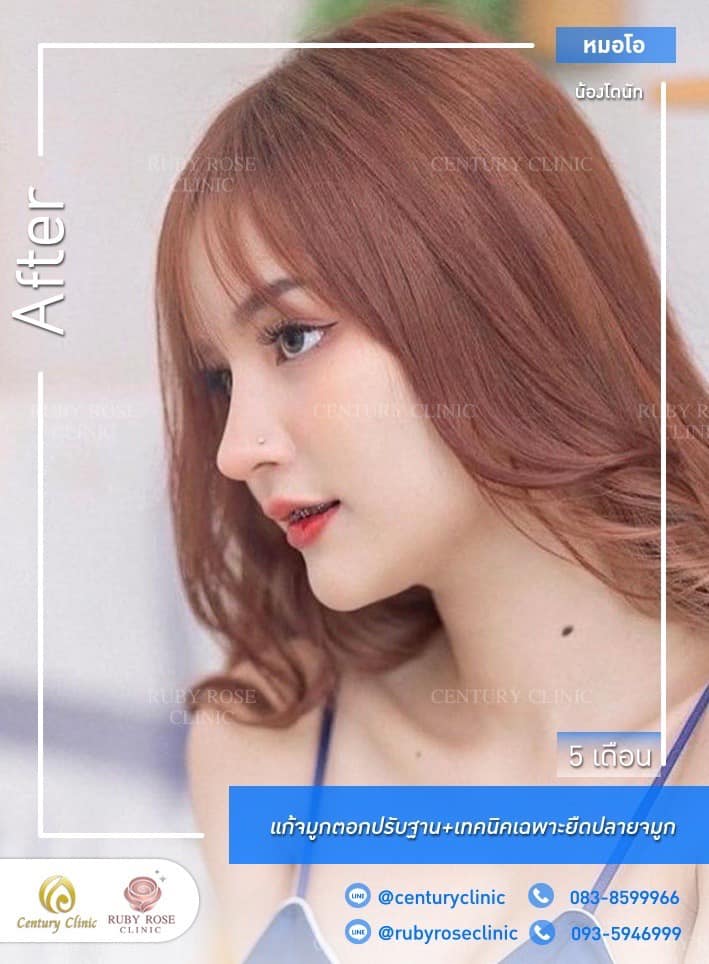 Century-รีวิว-แก้จมูก #421