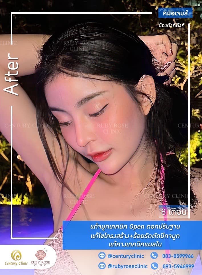 Century-รีวิว-แก้จมูก-คาง #410
