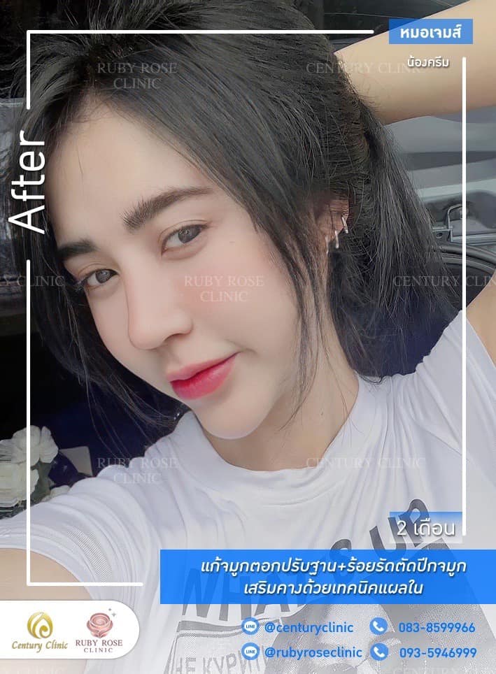Century-รีวิว-แก้จมูก-เสริมคาง #390