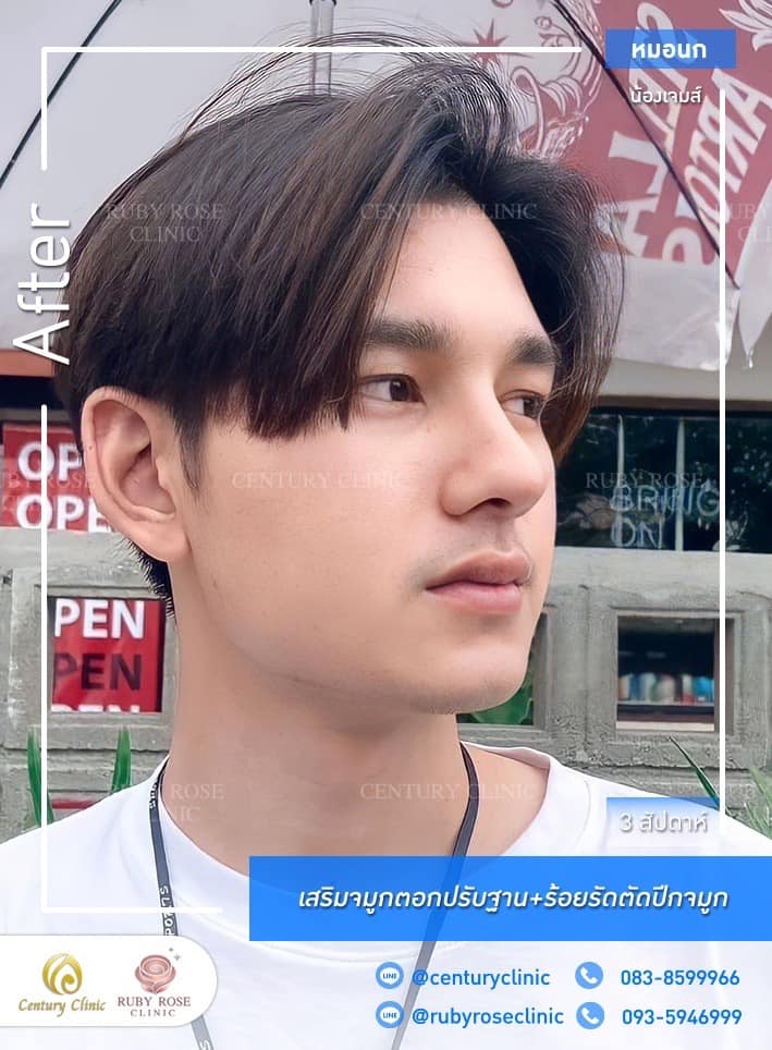 Century-รีวิว-เสริมจมูก 1#426