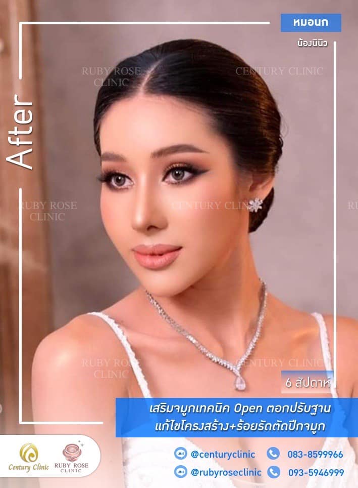 รีวิว เสริมจมูก #441 , Century Clinic Thailand Century-รีวิว-เสริมจมูก 1#441