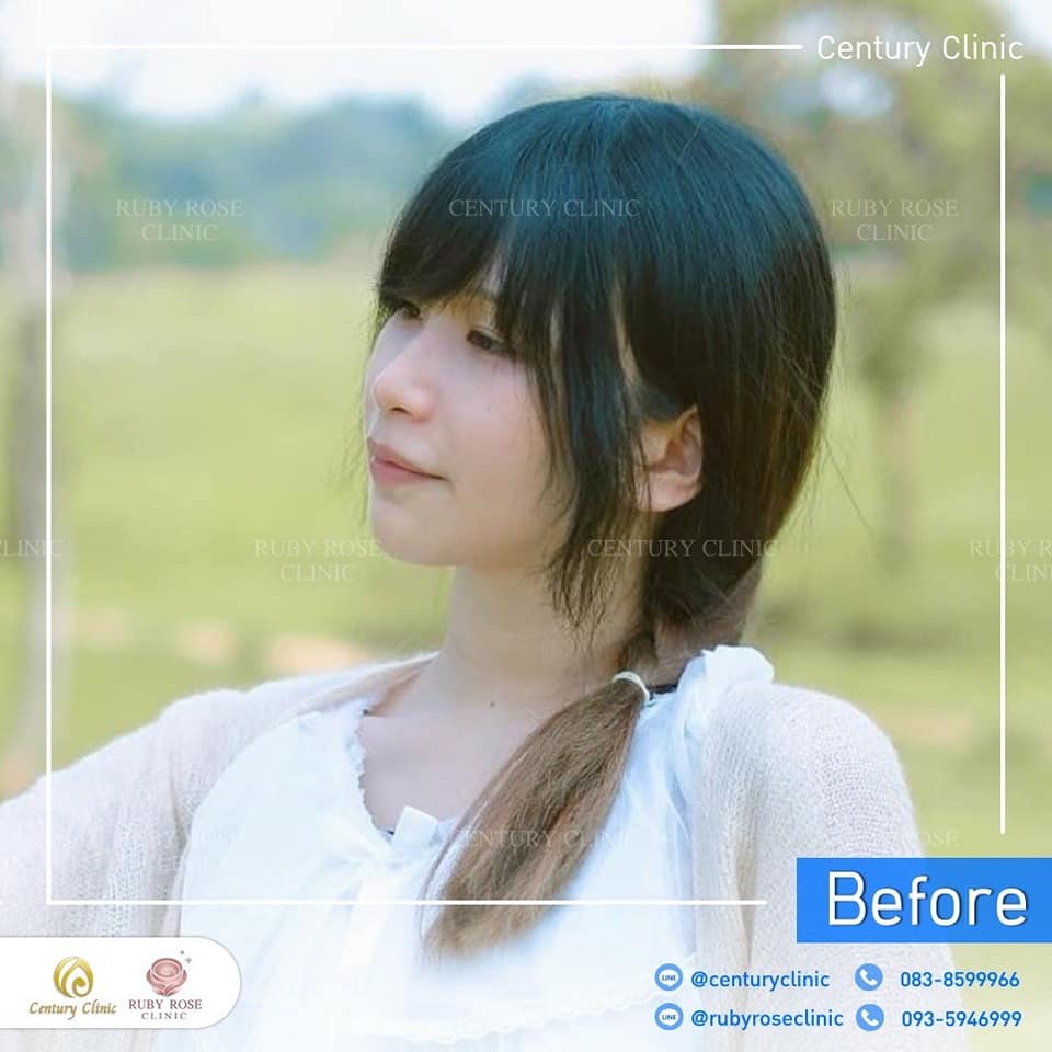 รีวิว เสริมจมูก #453 , Century Clinic Thailand Century-รีวิว-เสริมจมูก 1#453