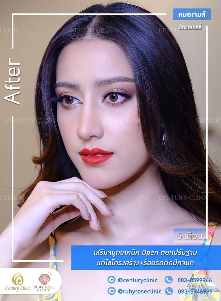 Century-รีวิว-เสริมจมูก 1#456
