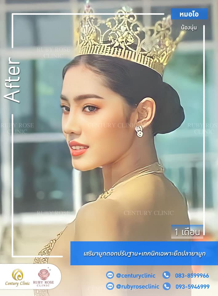 รีวิว เสริมจมูก #458 , Century Clinic Thailand Century-รีวิว-เสริมจมูก 1#458