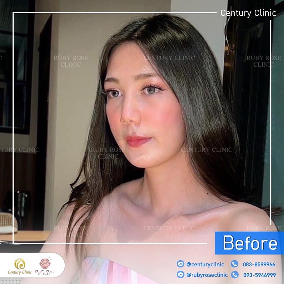 Century-รีวิว-เสริมจมูก 1#459