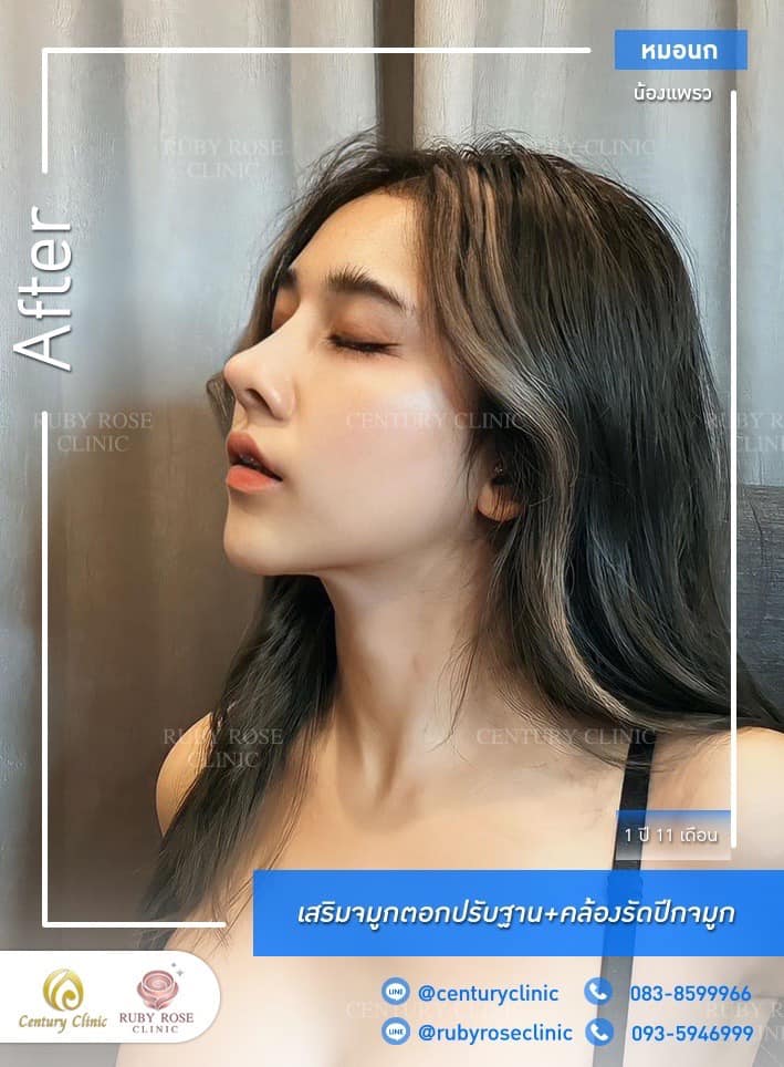 รีวิว เสริมจมูก #462 , Century Clinic Thailand Century-รีวิว-เสริมจมูก 1#462