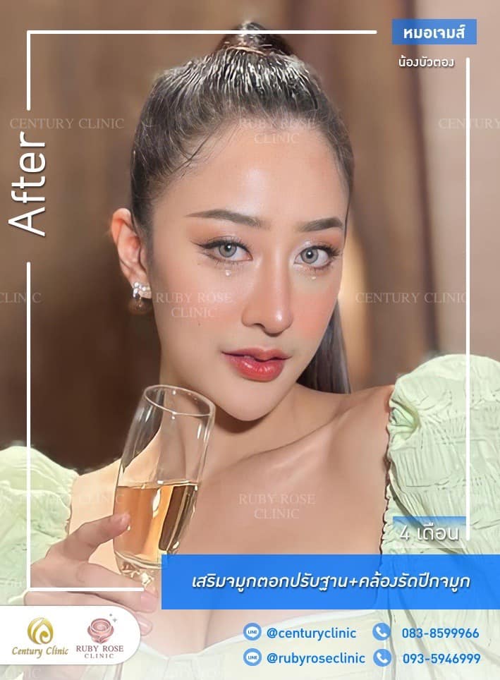 รีวิว เสริมจมูก #466 , Century Clinic Thailand Century-รีวิว-เสริมจมูก 1#466